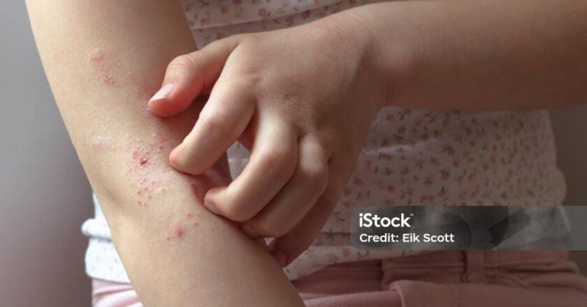 Süt Alerjisi Belirtileri Nelerdir? Süt Alerjisi Nasıl Anlaşılır? Tedavi Yöntemleri Nelerdir?