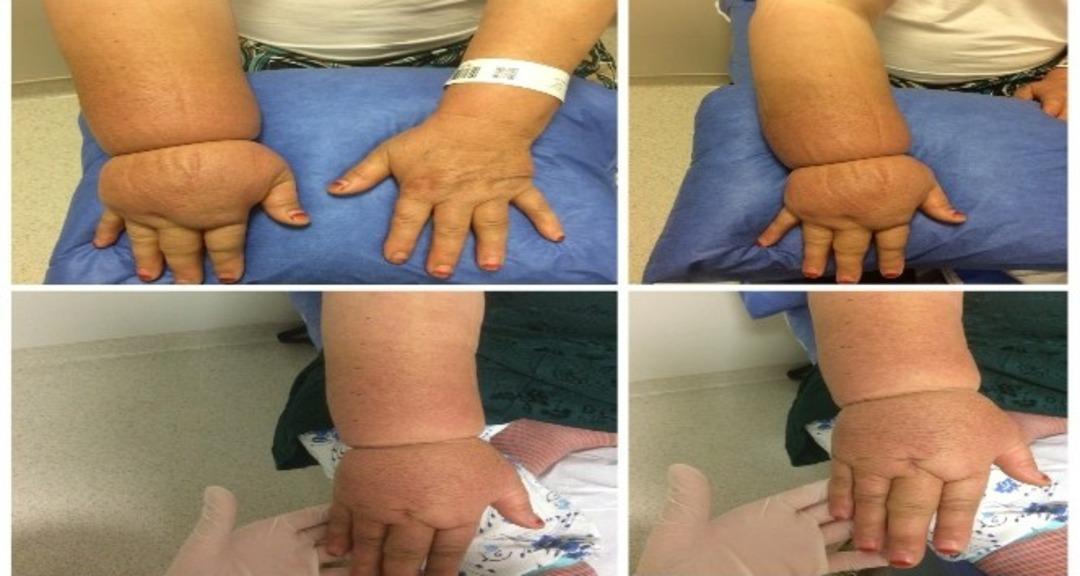 Bir ayağınız diğerinden büyükse dikkatli olun: tek taraflı şişlik lenfödem belirtisi olabilir 3